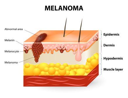 лечение меланомы в южной корее
