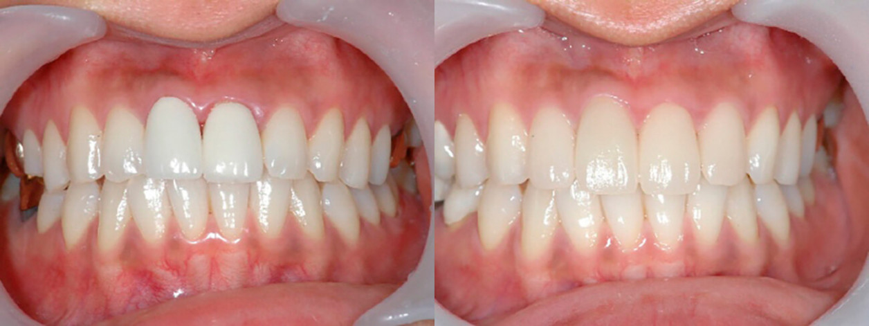 Пациентка в возрасте 28 лет, коронки на передние зубы были установлены давно, возникло воспаление десны.  Из-за активного образа жизни пациентка выбрала программу реставрации зубов за один день при помощии использования системы СЕРЕК. Пациентка осталась о