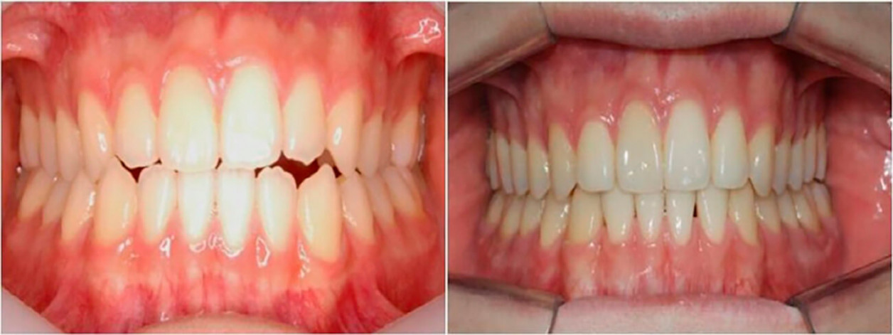 Прекрасный результат исправления прикуса зубов в области ортодонтии имеет прямую зависимость от грамотного диагностирования проблем с зубами, разработанной индивидуально для каждого пациента и выполненной квалифицированным специалистом схемы лечения.